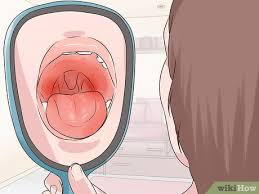 Image result for Uvulitis