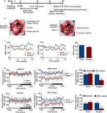 Effect Of Metabolic Surgery On Blood Pressure In Spontaneous