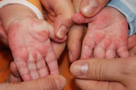 Palmar erythema causes palmar erythema is an often overlooked physical finding, is due to several physiologic or systemic pathologic states. Lane S Disease Erythema Palmare Hereditarium A Report Of Five Cases And A Review Of The Literature Gurioli 2017 Pediatric Dermatology Wiley Online Library