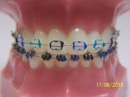 Black And Purple Braces Color Fashionable Braces General Dentist Orthodontics Braces Braces Colors Orthodontics Braces Braces