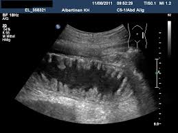 More images for darmverschluss ileus » Darmverschluss Akuter Deximed