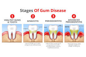 Keeping gums healthy is an important part of having healthy teeth, and a winning smile. What To Do To Keep Gums Healthy Deevees