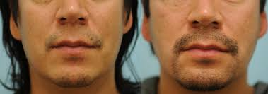 Hair transplant centers in india, especially those located in crowded cities like mumbai, delhi and ncr, bangalore, chennai, ahmedabad, kolkata, chandigarh, pune and hyderabad are equipped with the most advanced hair transplant equipments in the industry. Facial Hair Restoration Dallas Facial Hair Transplant Plano Tx