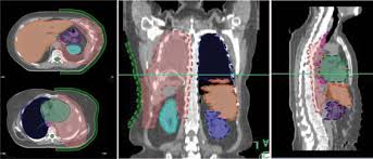 We did not find results for: Hemithoracic Radiotherapy After Extrapleural Pneumonectomy For Malignant Pleural Mesothelioma A Dosimetric Comparison Of Two Well Described Techniques Journal Of Thoracic Oncology