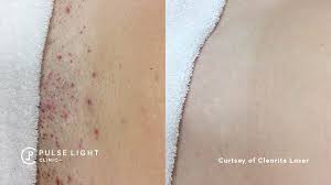 A southern bikini line ingrown hair extraction. Itd Sastati Stan How To Get Rid Of Ingrown Hairs On Bikini Line Trustconsulting Group Com