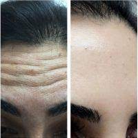 Can you exercise before botox? How Soon After Botox Can I Exercise Exercise Poster