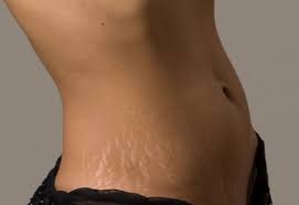 How To Get Rid Of Stretch Marks Naturally Stretchmarksremedies Body Photography Stretch Marks Skin