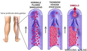 Embolia, është një formacion i pazakontë për gjakun, e cila pasi hynë në brendësinë e shtratit vaskular, bashkëudhëtonë, deri sa të arrin të bllokoj një segment terminal të vases.fjala embol vjen nga fjala greke embolon që do të thotë piston. Tromboembolia Polmonare Epidemiologia Cause Fattori Di Rischio Medicina Online