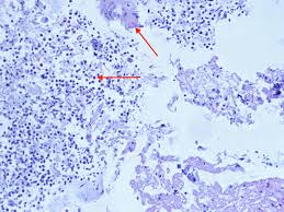 We did not find results for: Cureus A Rare Case Study About Necrotizing Granulomatous Sarcoidosis