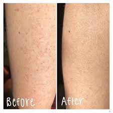Since keratosis pilaris affects the skin around the hair follicle, laser hair removal isn't exactly a home run treatment for eliminating kp entirely. Keratosis Pilaris Ace Dermatology Laser And Cosmetics Facebook