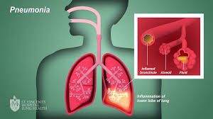 Women should measure just under the breasts. Pneumonia St Vincent S Lung Health