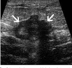 Rapid onset of symptoms (redness, swelling, warmth, itching, skin thickening) are hallmarks of the disease. Figure 5 From Sonographic Features Of Inflammatory Breast Cancer Semantic Scholar