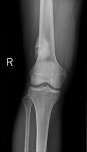 Teratomas are the most common germ cell tumor found in the ovaries. Primary Malignant Bone Tumors Musculoskeletal And Connective Tissue Disorders Merck Manuals Professional Edition