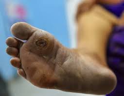 Image result for diabetic toes