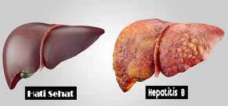 Penyakit kuning berarti penampilan kuning kulit dan putih mata yang terjadi saat darah mengandung kelebihan pigmen yang disebut bilirubin. Apakah Kita Bisa Sepenuhnya Membasmi Virus Hepatitis B Yang Menginfeksi Seseorang Galena