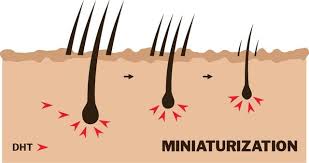 Female pattern hair loss due to dht affects about 30 million women. What Is Dht Advanced Hair Studio Shop