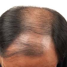 An article in the journal of cutaneous and aesthetic surgery cites a. Saw Palmetto Hair Loss Invisi Hair Loss Treatment