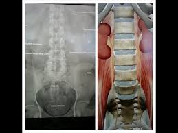 X Ray Kub Basics Kidney Ureter Bladder Youtube