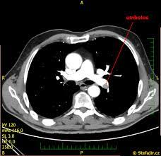 Plicní embolie (pe) popisuje zablokování plicní arterie nebo jedné z jejích větví krví sraženinou nebo cizorodým materiálem. Nalez 15 Plicni Embolie Medicina Nemoci Studium Na 1 Lf Uk