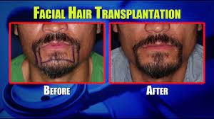 It is common to see individuals who are unable to grow a complete goatee or mustache. Facial Hair Transplants For Men Youtube