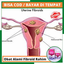 Tips untuk menyembuhkan tumor fibroid. Obat Alami Fibroid Rahim Herbal Untuk Mengobati Tumor Jinak Pada Rahim Menyembuhkan Nyeri Panggul Berhubungan Seksual Akibat Fibroid Tradisional Buat Obati Fibroid Rahim Untuk Wanita Walatra Sehat Wanita