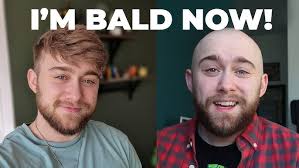 TRANSGENDER FACIAL HAIR & MINOXIDIL