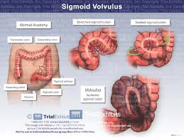Image result for Sigmoid Volvulus