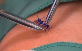 Stitches