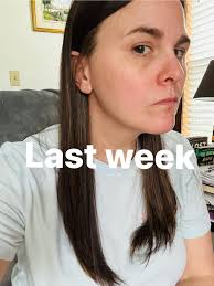 Hi everyone! I am about a month before surgery. My biggest fear is hair  loss. Is there anything I can do now to help with this issue. Otherwise I  am so excited