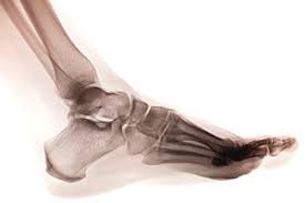 Image result for Calcaneal Apophysitis