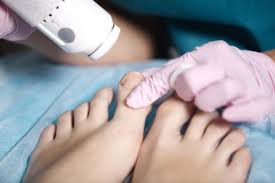 See more ideas about toenail fungus, foot fungus, athletes foot. What Is The Best Toenail Fungus Treatment