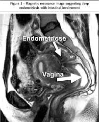 Endometriosis is a condition in which tissue resembling the endometrium — the tissue that lines the uterus — starts growing outside the uterus, forming lesions. Scielo Brasil Endometriose Intestinal Uma Doenca Benigna Endometriose Intestinal Uma Doenca Benigna