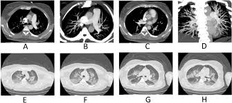 Image result for High Altitude Edema