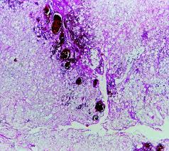 Image result for Liposarcoma