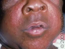 Image result for yellow scabs on the face in children