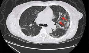 Transurethral resection of the prostate. Chest Ct Scan Of A Patient With Bronchiectasis Not Due To Cystic Fibrosis Download Scientific Diagram
