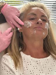 When Vicki came to me she hadn't had any aesthetic treatments, this is her  tweakment journey. — Samantha Carron Aesthetics Ltd