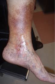 Image result for Localized Edema