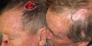 If you have skin cancer, it is important to know which type you have because it affects your treatment options and your outlook (prognosis). Scalp Reconstruction Gallery Skin Cancer And Reconstructive Surgery Center