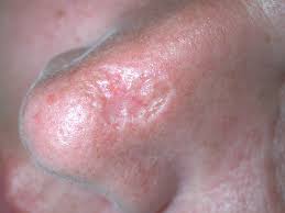 Osterreichische Gesellschaft Fur Dermatochirurgie Ogdc