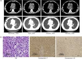 Let us know if you find out for sure. Spontaneous Remission Of A Non Small Cell Lung Cancer Possibly Caused By Anti Ny Eso 1 Immunity Lung Cancer