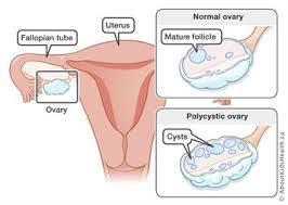An endocrine society clinical practice guideline. Polycystic Ovaries Syndrome Pcos