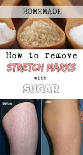How To Remove Stretch Marks With Sugar Diy Stretch Marks Cream Stretch Marks Stretch Mark Remedies