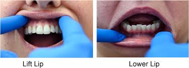 Image result for Lip Exam