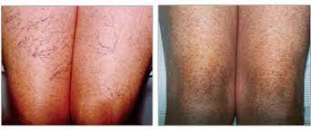 Vein Center Cosmed Sclerotherapy For Leg Spider Veins In St Louis