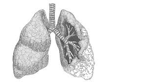 Fortunately, thanks to vast medical knowledge and advances in technology, there are treatment options available for mesothelioma. Asbestos Exposure And Mesothelioma Lawsuits Mcintyre Law