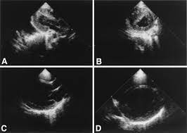 The duration of problems can vary from hours to months. Echocardiographic Findings In Fulminant And Acute Myocarditis Sciencedirect