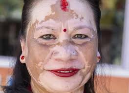 Image result for Vitiligo