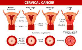 The doctor also may order lab tests, imaging tests (scans), or other tests or procedures. Cervical Cancer Victory Brokerage Inc Helping Agents Write Life Insurance