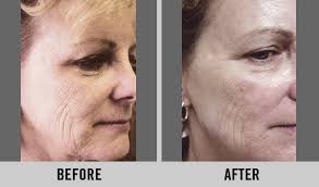 Customized Facials & Peels